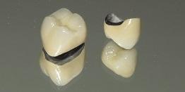 Crowns 4 Great Stuart Street Dental Practice