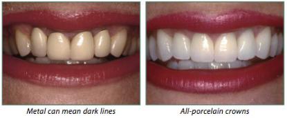 Crowns EH10 Dental